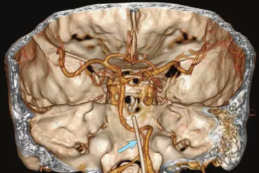 Best CT Scan in Bhiwadi India, Low Radiation Dose CT in Bhiwadi India, lowest cost of CT Scan in Bhiwadi, CT Scan of Brain in Bhiwadi, CT Scan at Bharat Diagnostics Bhiwadi, CT Scan of Abdomen Bhiwadi, CT Scan in Bhiwadi, Cost of CT Scan in Bhiwadi